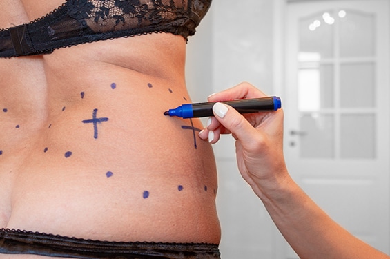 a liposuction surgeon marks out where incisions will be made on a woman’s abdomen