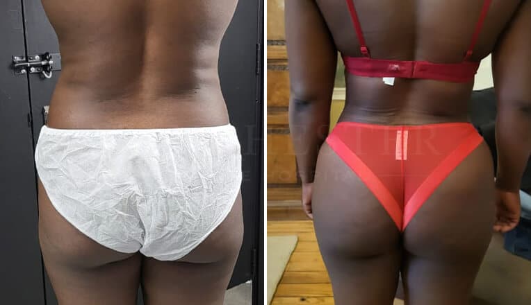 love handles liposuction before and after