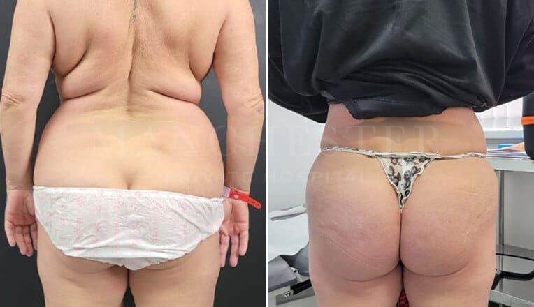 upper and lower back before and after