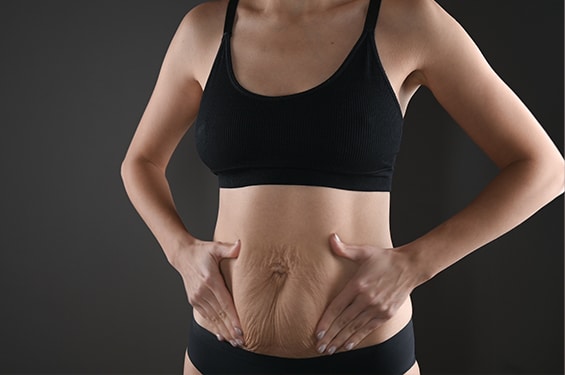 a woman with stretch marks and loose skin on her abdomen cups her tummy