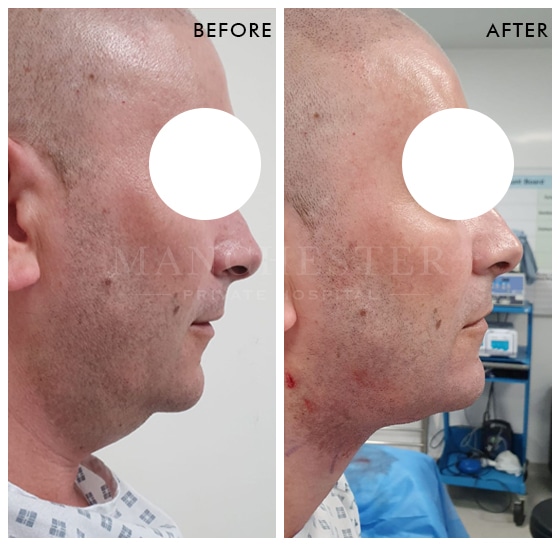 double chin liposuction before and after result