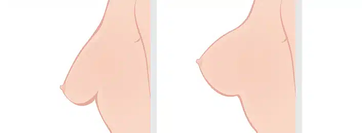 Combined Breast UpLift & Breast Enlargement Surgery  (Augmentation-Mastopexy)in Cambridge & Peterborough