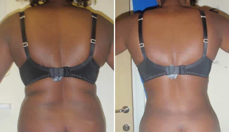 back vaser liposuction before and after