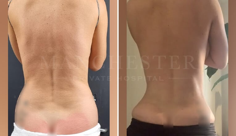 back vaser liposuction before and after by mr fiore-1