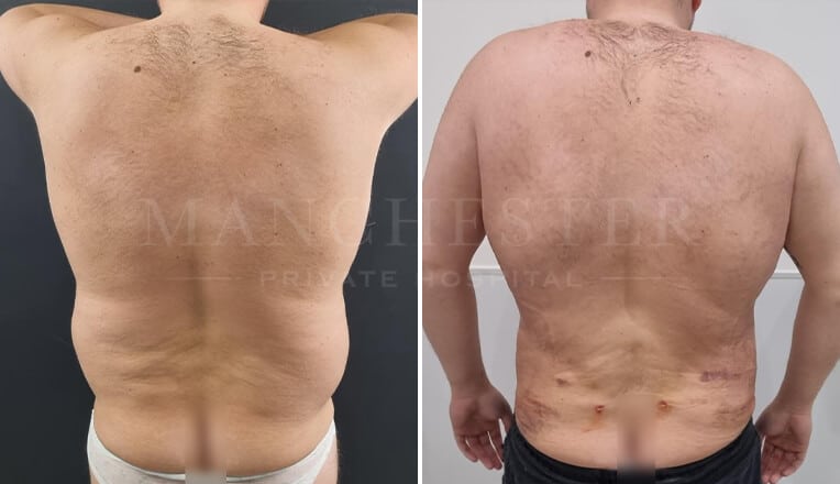 back vaser liposuction before and after by mr fiore-2