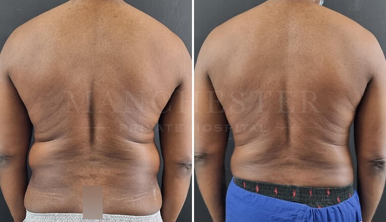 back vaser liposuction before and after by mr fiore