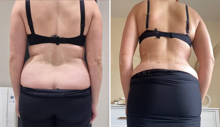 back vaser liposuction before and after by mr fiore