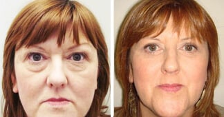 blepharoplasty-before-and-after-1