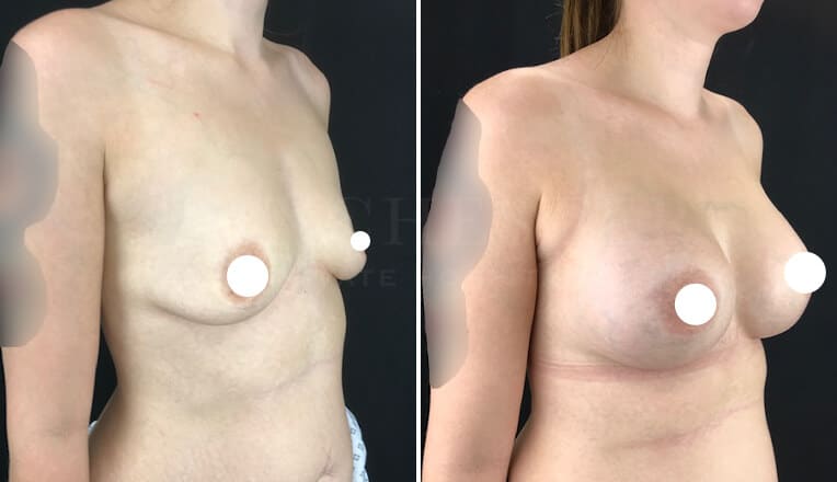 boob job manchester before and after