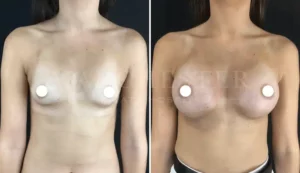 boob job breast enlargement manchester before and after