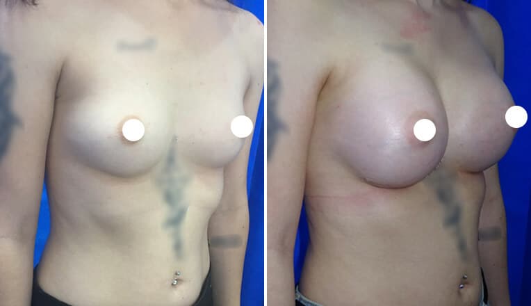 boob job manchester before and after