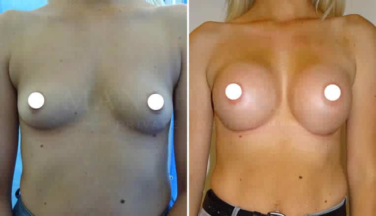 boob job before and after