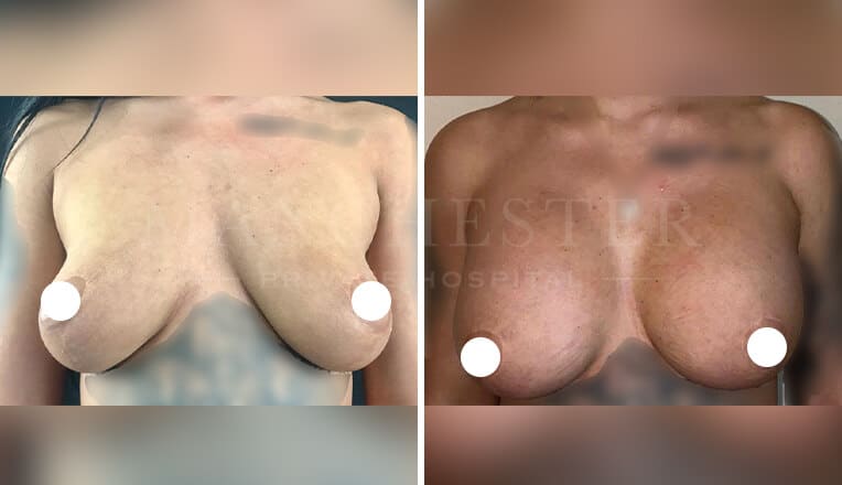 breast enlargement before and after