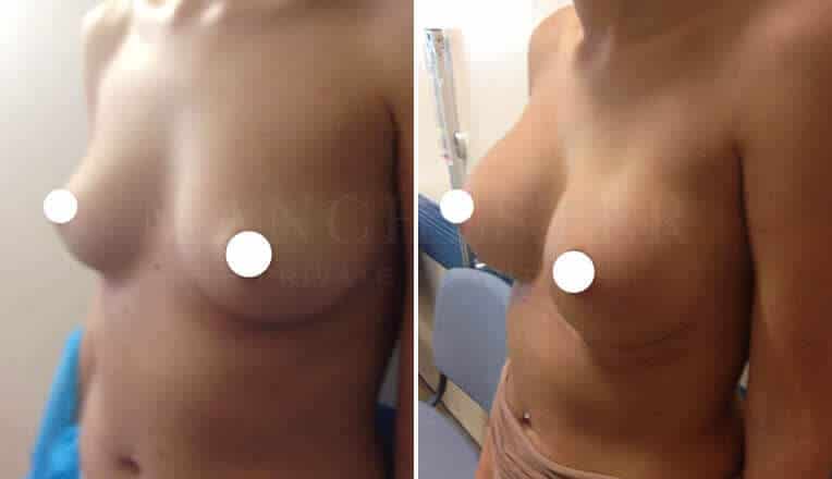 breast enlargement before and after