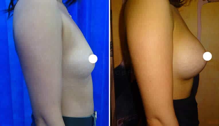 breast enlargement before and after