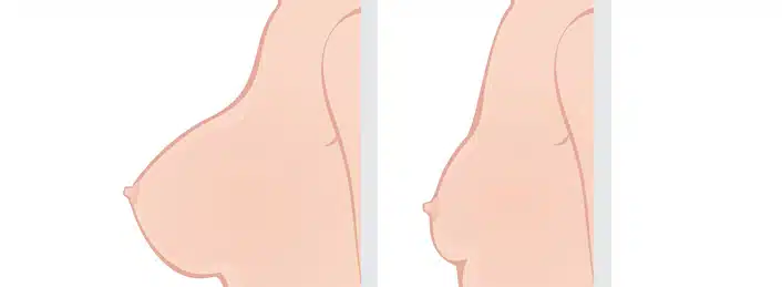 breast reduction before and after