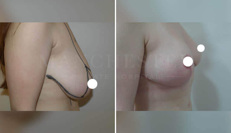 breast reduction surgery before and after