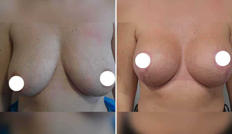 breast uplift before and after