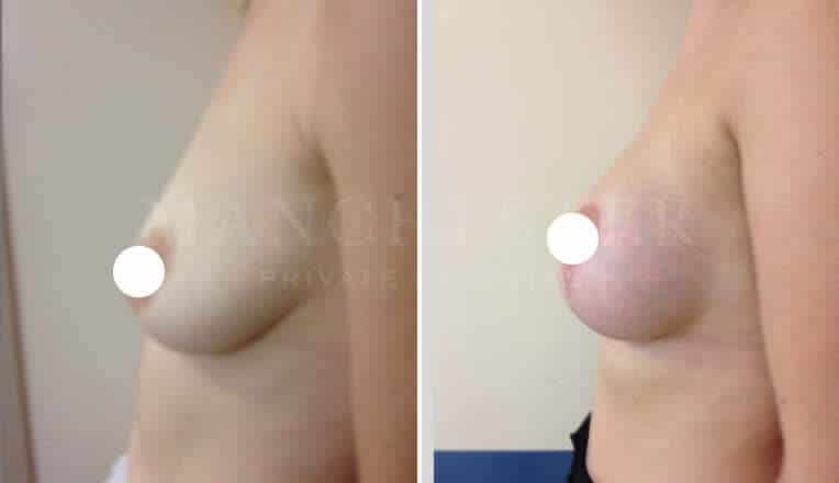 breast uplift before and after