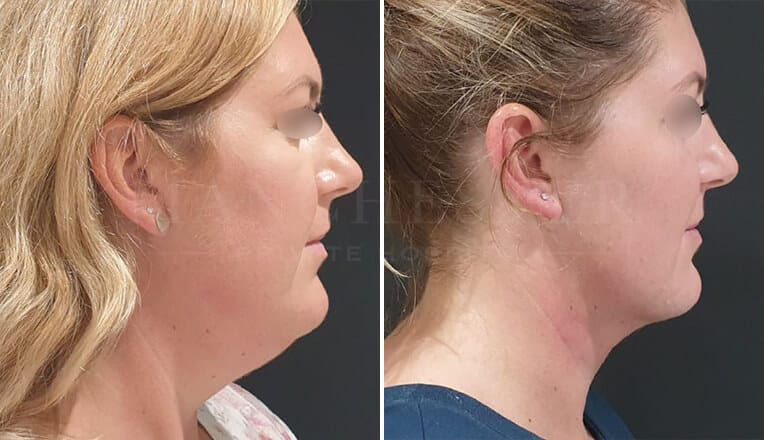 face liposuction before and after
