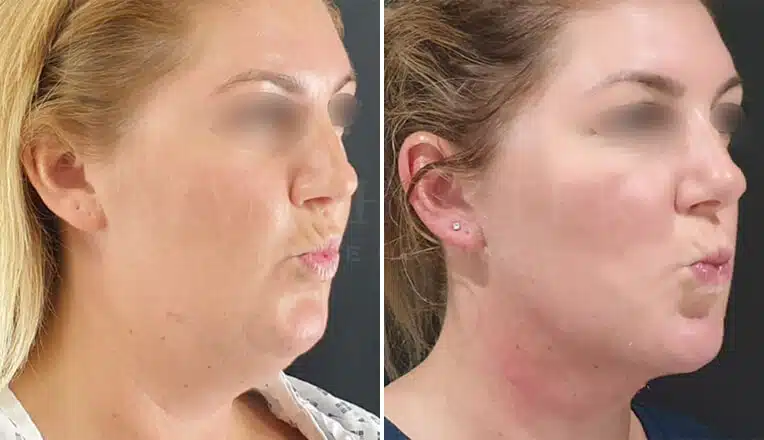 facial lipo before and after