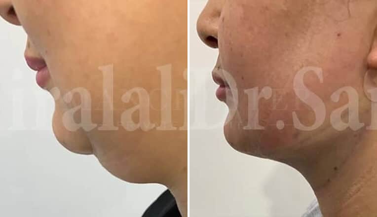 facial liposuction before and after