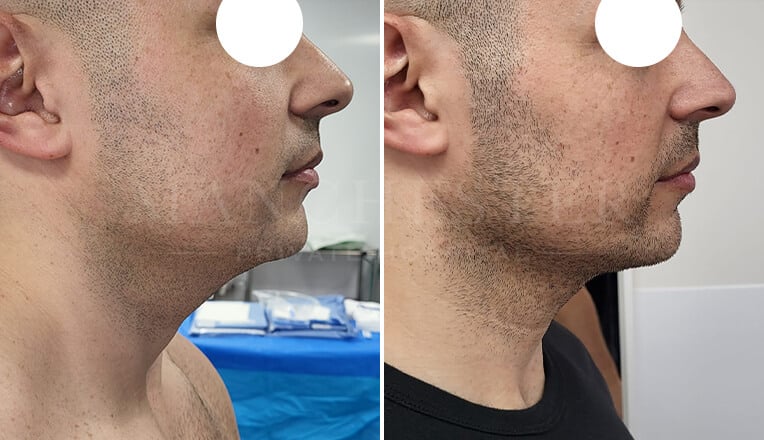facial liposuction before and after by dr kam singh