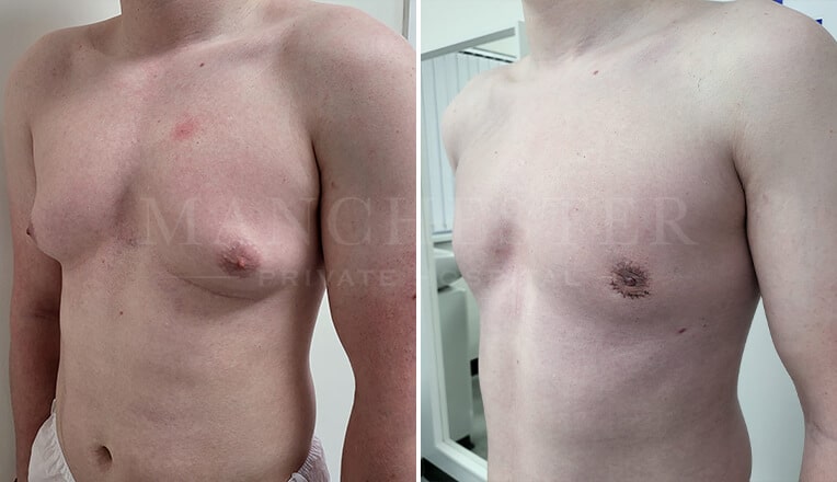 gynecomastia before and after by dr kam singh