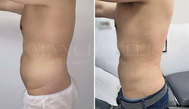 men vaser lipo before and after by dr kam singh