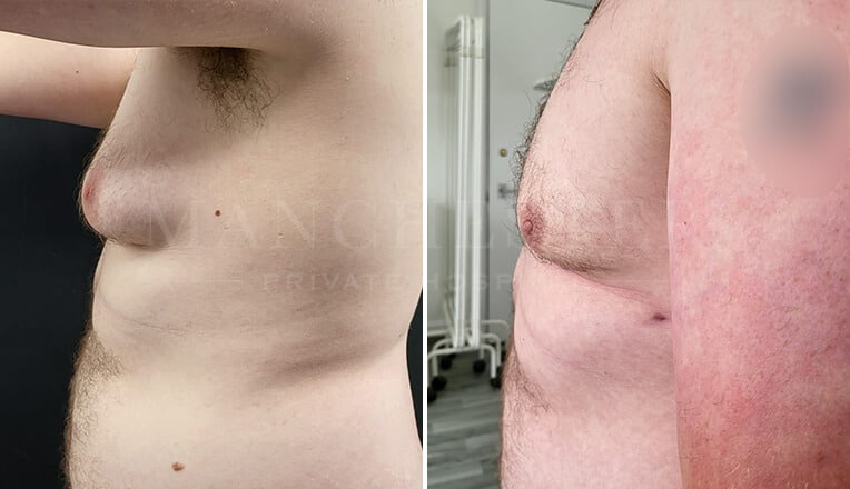 gynecomastia before and after by dr kam singh