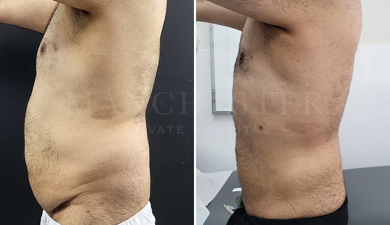 male vaser lipo before and after by dr kam singh