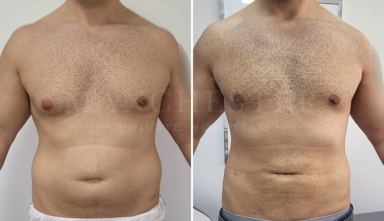 vaser lipo before and after by dr kam singh