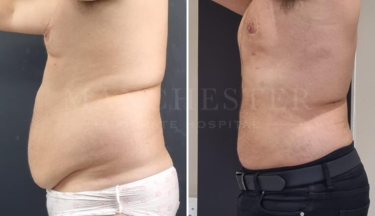 gynecomastia before and after surgery by mr fiore-1