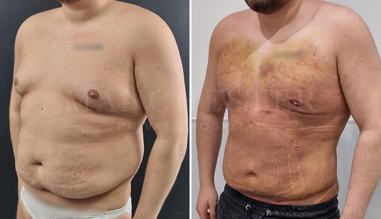 gynecomastia before and after surgery by mr fiore-11
