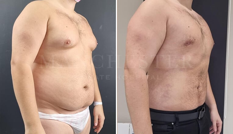 gynecomastia before and after surgery by mr fiore-2
