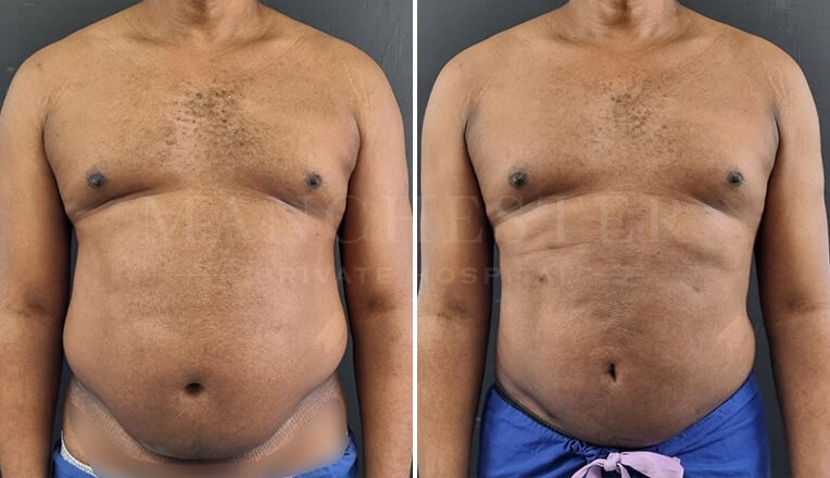 gynecomastia before and after surgery by mr fiore-3
