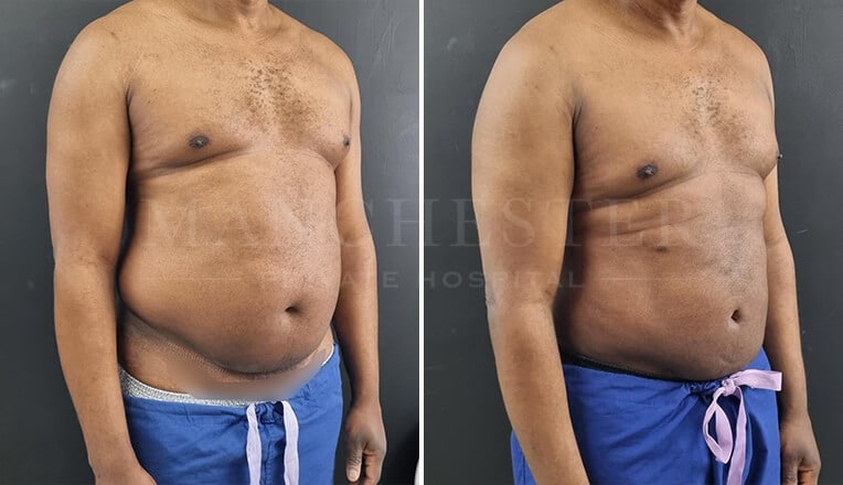 gynecomastia before and after surgery by mr fiore-5