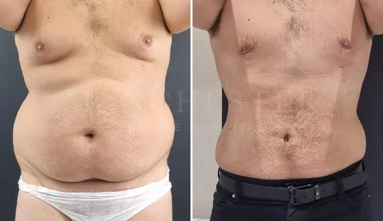 gynecomastia surgery before and after
