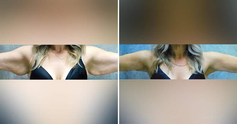 j plasma before and after arms