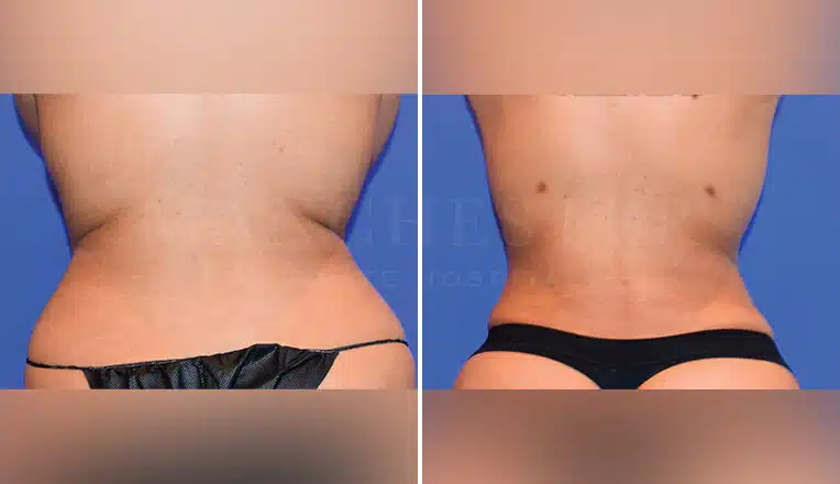 j plasma before and after belly