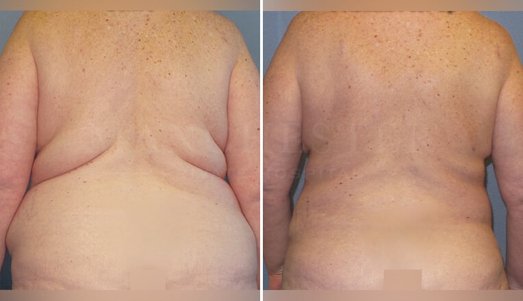 j plasma before and after belly
