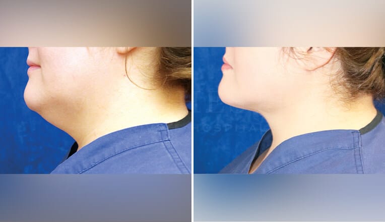 j plasma before and after chin