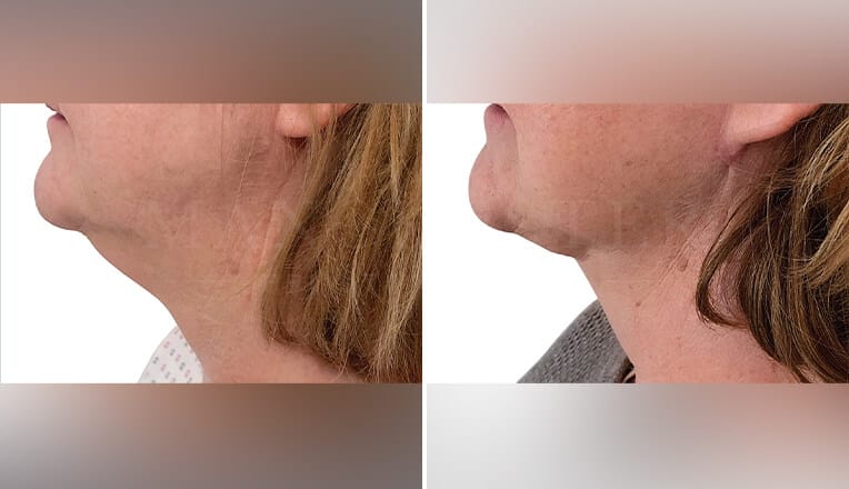 j plasma before and after chin