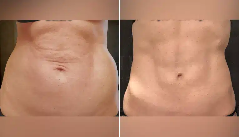 j plasma renuvion before and after