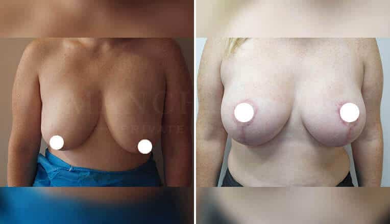 large breast lift before and after
