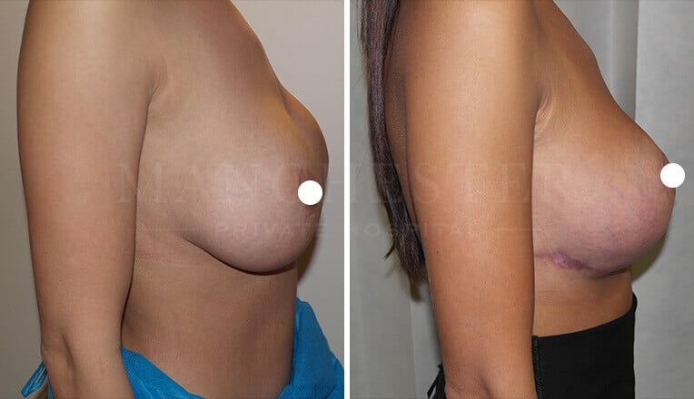 large breast lift before and after