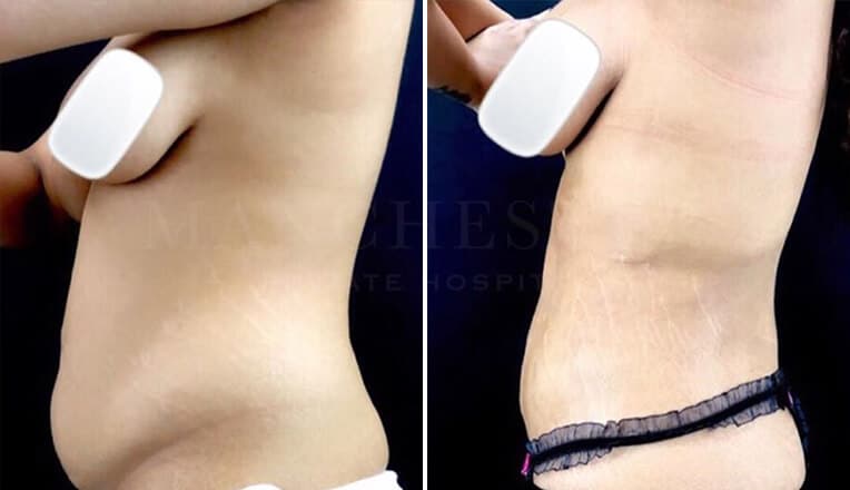mini tummy tuck before and after