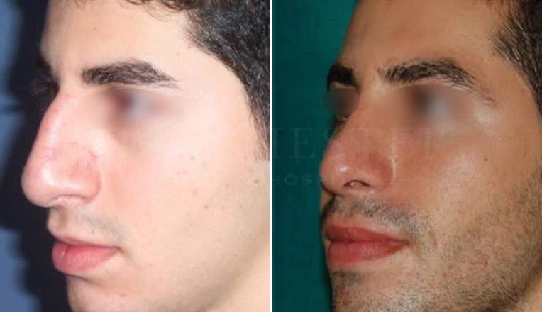 nose job before and after result