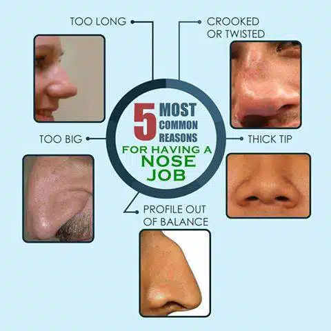 Nose Surgery