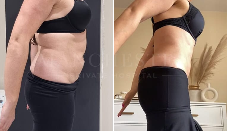 vaser lipo before and after result by mr fiore-2